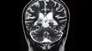 Front Brain Scan MRI Image